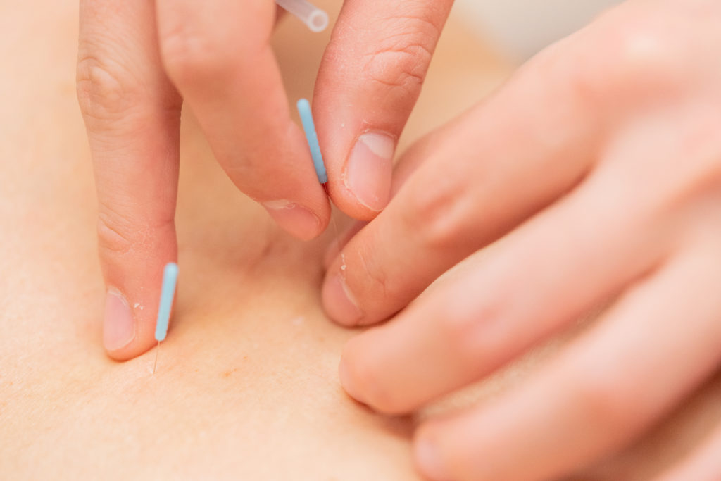 鍼治療のイメージ